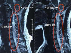 脊髓空洞症