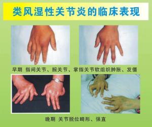 类风湿性关节炎