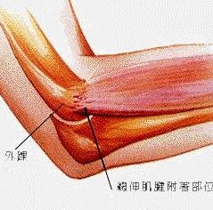 网球肘