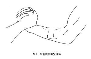 旋前圆肌综合征