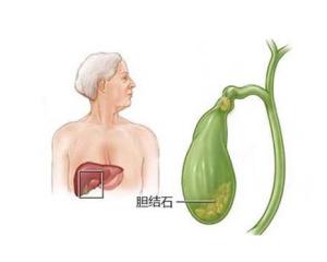 胆结石