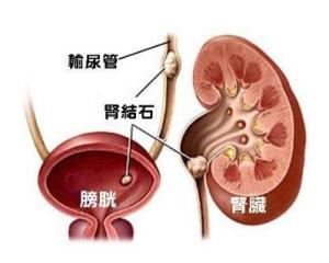 肾结石