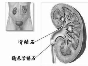 肾结石