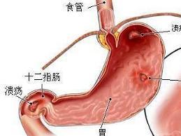 溃疡病穿孔