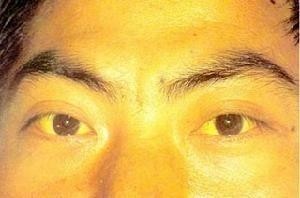 药物导致黄疸