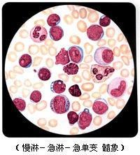 溶血性贫血