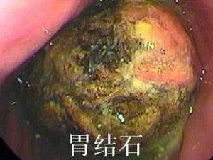 胃结石