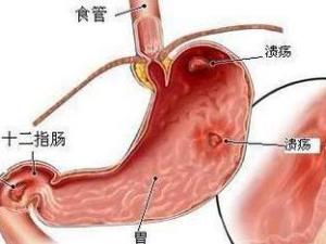 胃穿孔