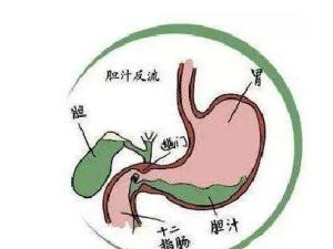 胆汁反流性胃炎