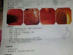 胆汁反流性胃炎