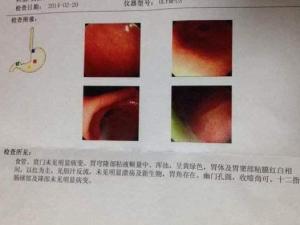 胆汁反流性胃炎