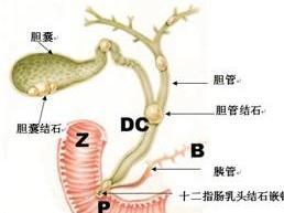 肝内胆管结石