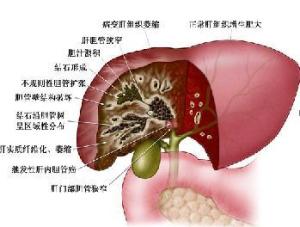 肝内胆管结石