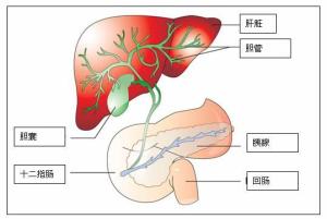 肝内胆管结石