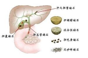 肝内胆管结石