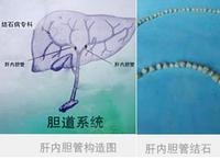 肝内胆管结石