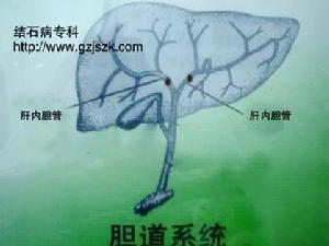 肝内胆管结石