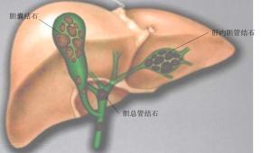 肝内胆管结石