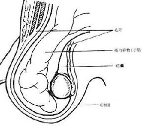 腹股沟斜疝