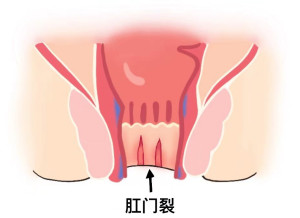 肛门裂