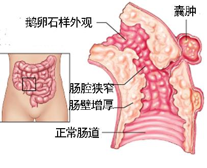 克罗恩病