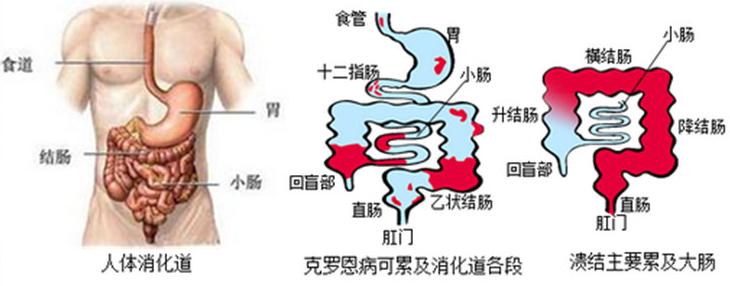 克罗恩病