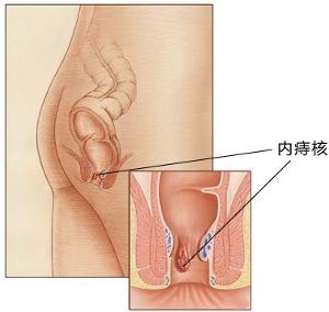 内痔