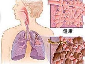 肺气肿
