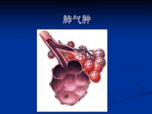 肺气肿