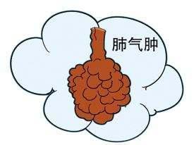 肺气肿