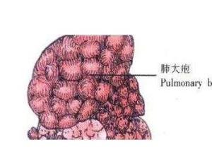 肺大泡