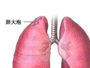 肺大泡
