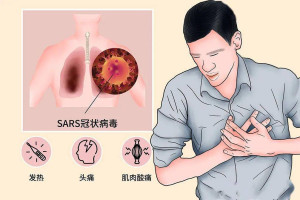 重症急性呼吸综合征