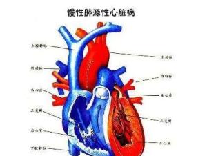肺源性心脏病