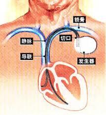 起搏器综合征