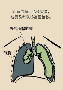 气胸图册