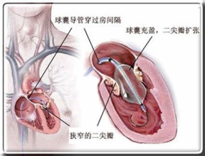 心肌病