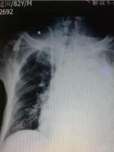 胸腔积液
