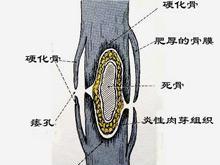 胸壁骨肿瘤