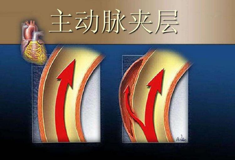 主动脉夹层