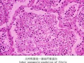 大叶性肺炎