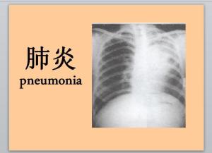 肺炎