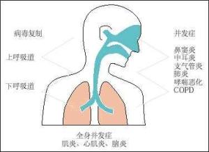 流感并发症
