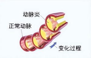 大动脉炎