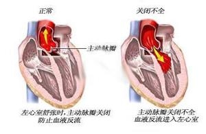 风湿性心脏病