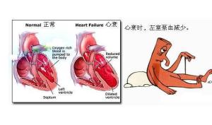 风湿性心脏病