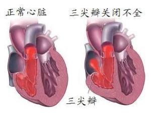风湿性心脏病
