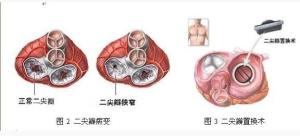 风湿性心脏病