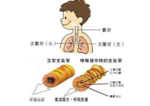 过敏性哮喘