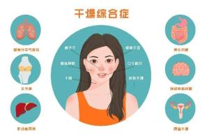 干燥综合征